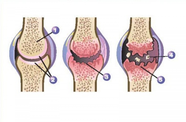 The Joints Are Jumping